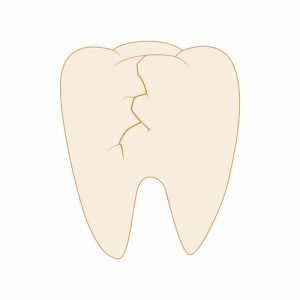 cracked tooth image