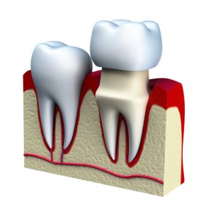 illustration of dental crown