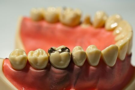 filling removal to find cracked tooth