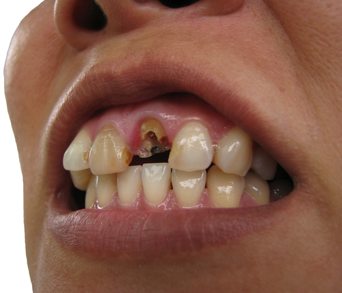 Cracked Tooth Treatments